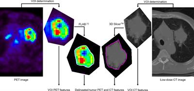 Accurate Tumor Delineation vs. Rough Volume of Interest Analysis for 18F-FDG PET/CT Radiomics-Based Prognostic Modeling inNon-Small Cell Lung Cancer